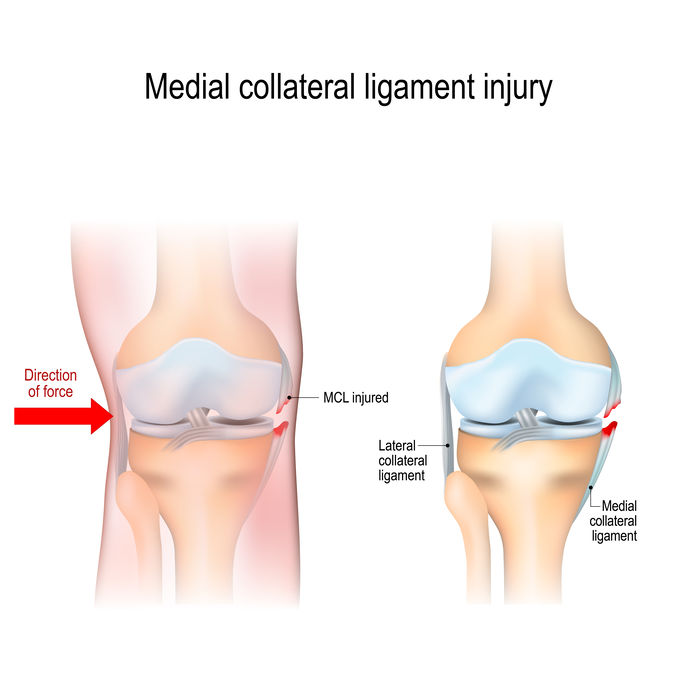 Collateraal band letsel, pijn binnen- en buitenzijde knie 